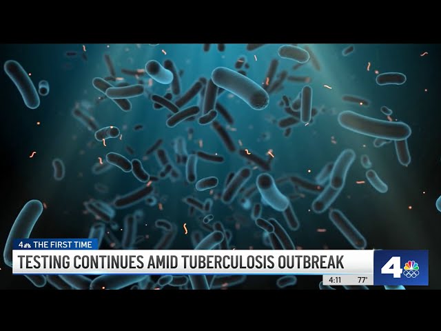 ⁣Half of tuberculosis cases in Long Beach linked to homeless housing