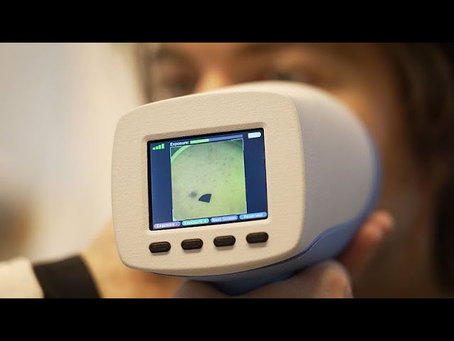 ⁣Une nouvelle technologie pour détecter les cancers de la peau en 30 secondes
