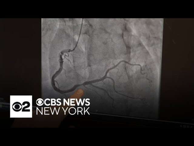 ⁣CBS cameraman discusses his genetic risk factor for heart disease