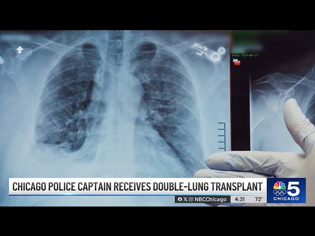 ⁣Chicago police captain undergoes double lung