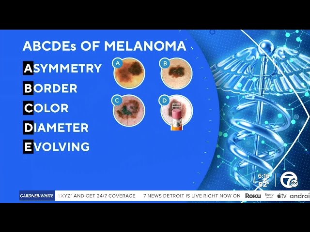 ⁣Signs to look out for with melanoma during Skin Cancer Awareness Month
