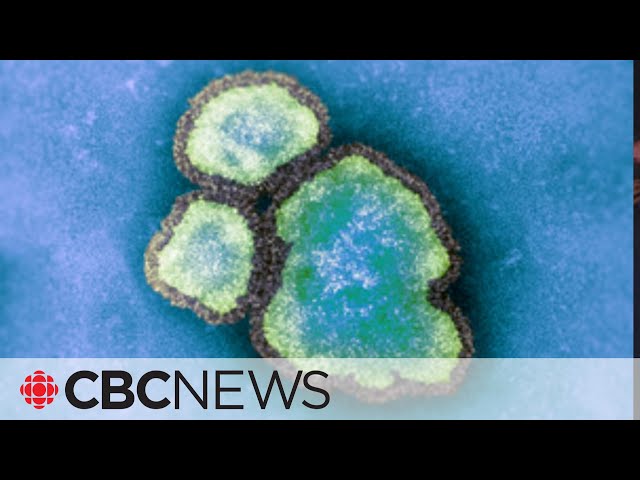 ⁣Child under 5 dies of measles, says Public Health Ontario