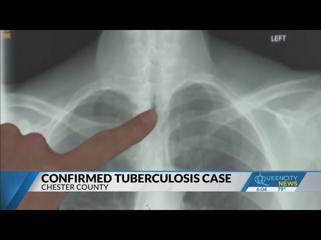 ⁣Tuberculosis case confirmed at Chester High School