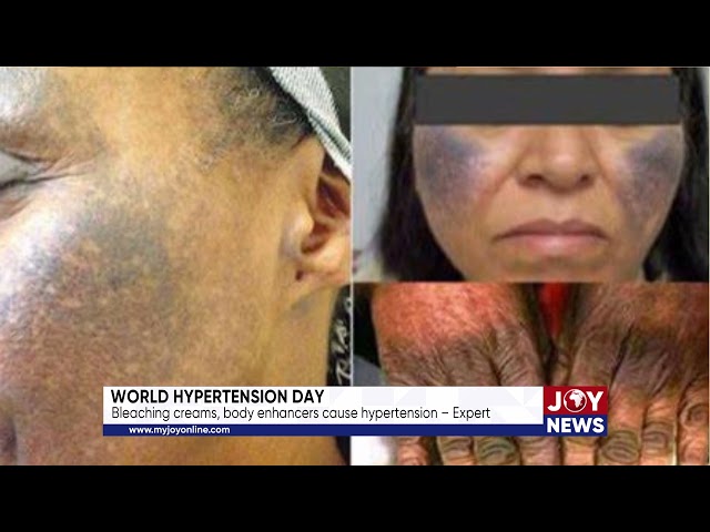 ⁣World Hypertension Day: Bleaching creams, body enhancers cause hypertension – Expert