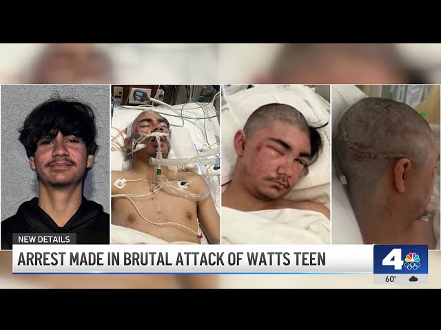 ⁣Teen victim of brutal assault undergoes second surgery