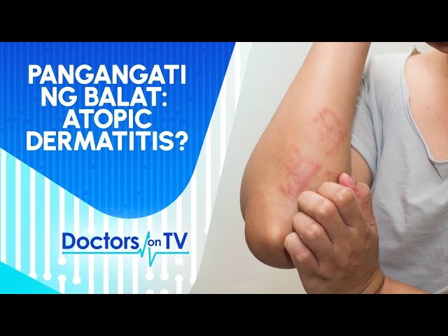 ⁣ALAMIN SA DOTV: Sakit sa balat o Atopic Dermatitis ano nga ba ang sanhi?