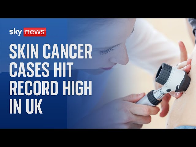 ⁣Melanoma skin cancer cases at all-time high in UK
