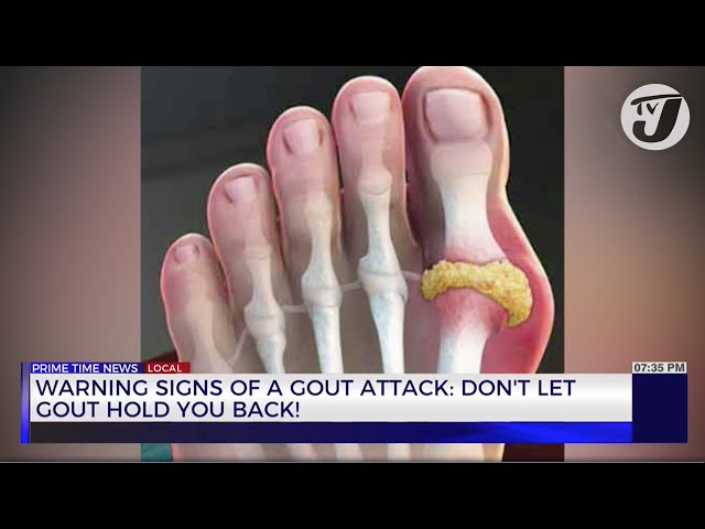 ⁣Warning Signs of a Gout Attact: Don't let Gout Hold you Back! | TVJ News
