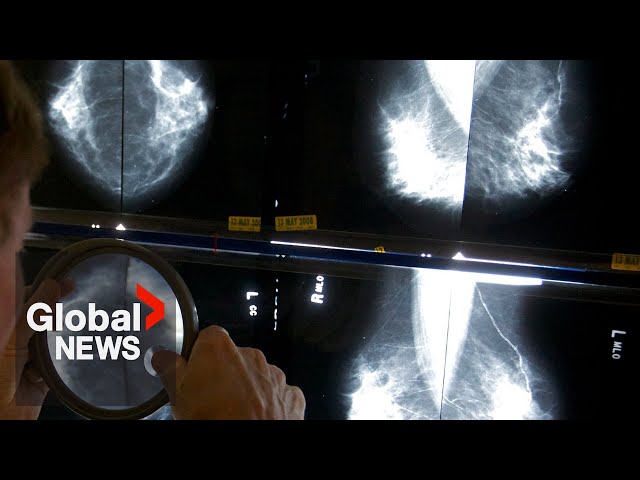 ⁣Breast cancer screening decision sparks review of Canada's task force