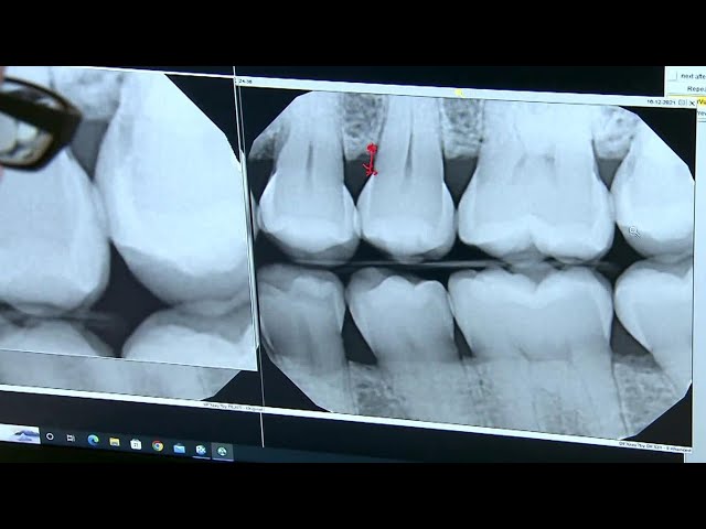 ⁣NDP's dental care coverage to expand in June