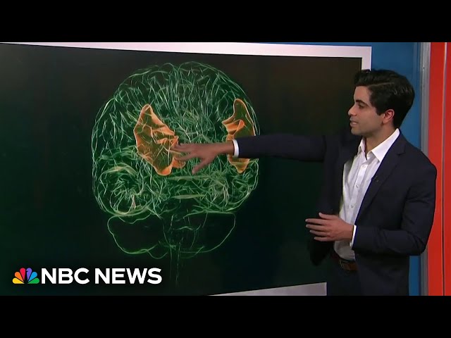 ⁣AI brain implant helps stroke survivor communicate in English and Spanish