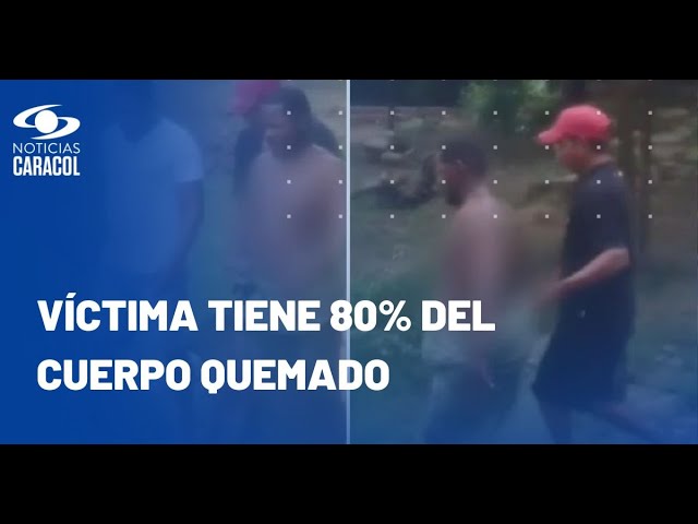 ⁣Mujer roció con gasolina a su expareja y le prendió fuego: aberrante caso en Cartagena