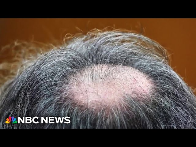 ⁣Some doctors worry about rare side effects from taking hair loss prevention drugs