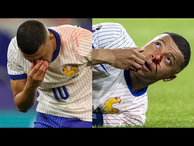 ⁣كيليان مبابي يتعرض للإصابة بكسر في الأنف خلال مباراة فرنسا والنمسا في بطولة كأس أوروبا 2024