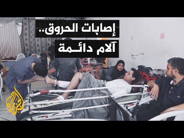 ⁣أصوات من غزة| في ظل نقص المراهم والمسكنات.. تفاقم معاناة المصابين بالحروق بسبب الحرب