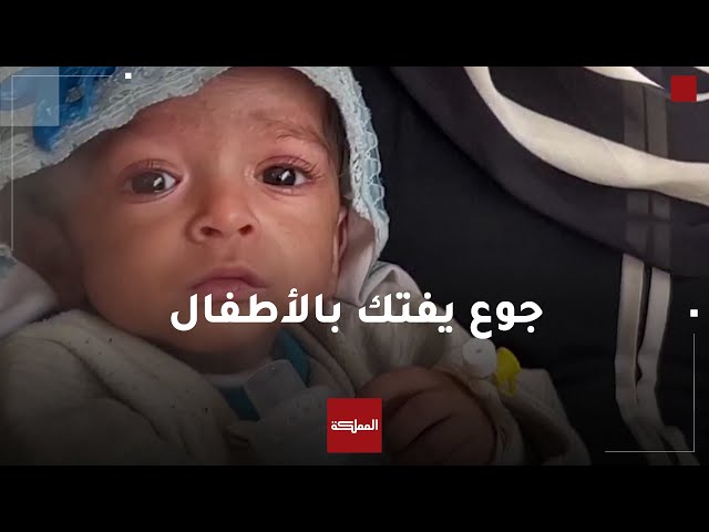 ⁣الجوع ينهش أجساد أطفال غزة