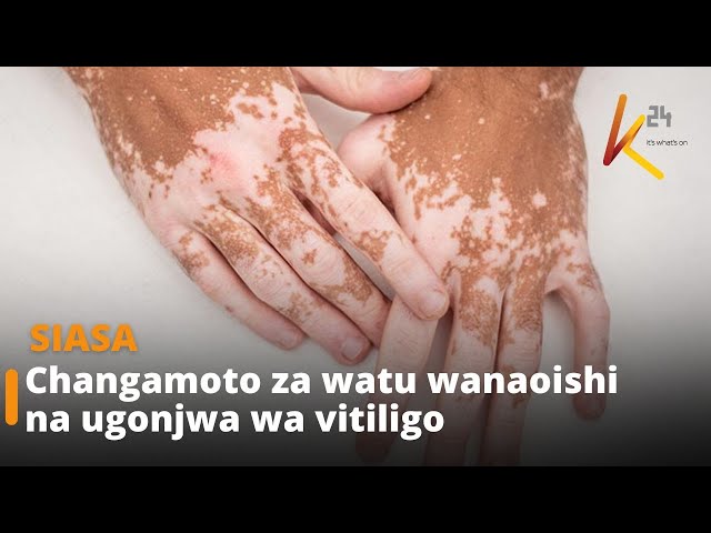 ⁣Changamoto za watu wanaoishi na ugonjwa wa vitiligo