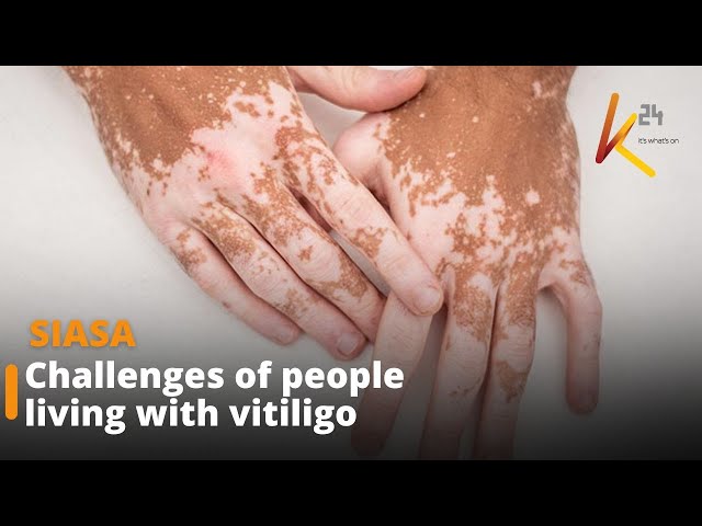 ⁣Challenges of people living with vitiligo