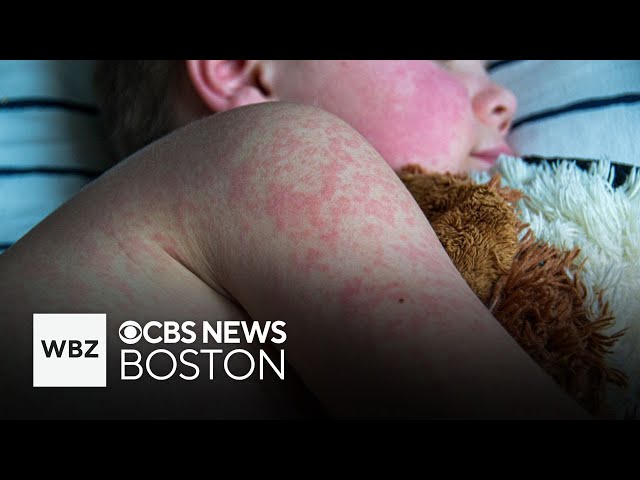 ⁣Possible measles exposure in New Hampshire and Massachusetts, residents urged to check for symptoms