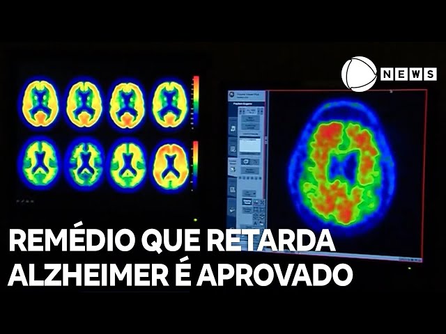 ⁣Remédio que retarda progressão do Alzheimer é aprovado