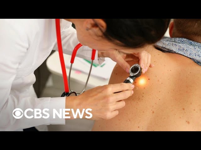 ⁣Dermatologists battle online "anti-sunscreen movement" spreading misinformation, health ri