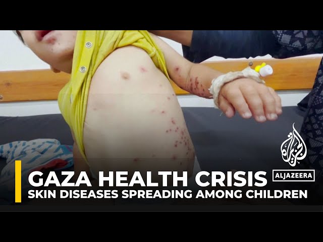 Dangerous skin diseases spreading among children in Gaza