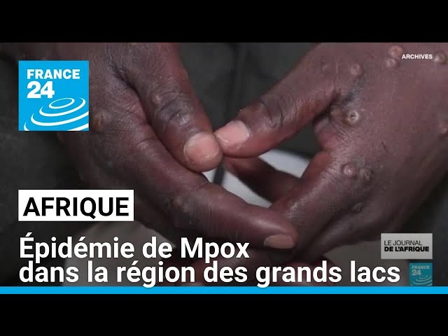 L'épidémie de Mpox se développe dans la région des grands lacs en Afrique • FRANCE 24