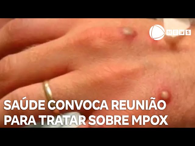 Ministério da Saúde convoca reunião para discutir plano contra mpox