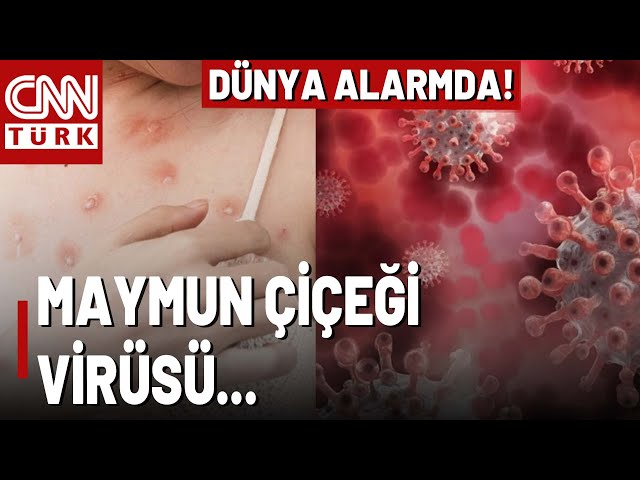 Dünya Ayakta! Maymun Çiçeği Virüsü Korku Saçıyor! Yeni Bir Koronavirüs Vakası Mı?