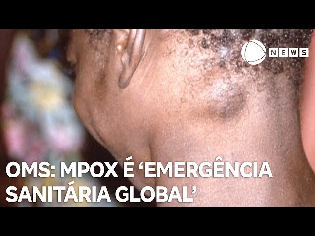 OMS classifica Mpox como 'emergência sanitária global'