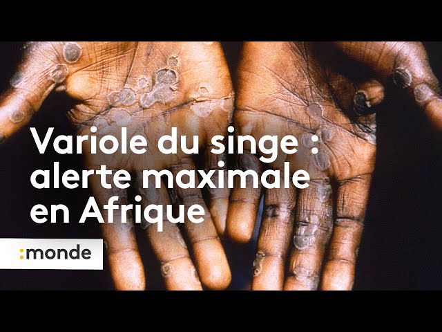 Variole du singe : alerte maximale en Afrique