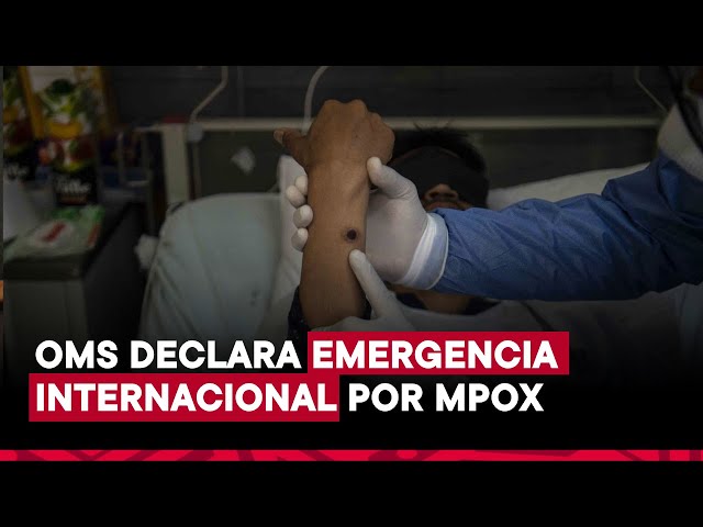 Viruela del mono es declarada emergencia de salud pública internacional por la OMS