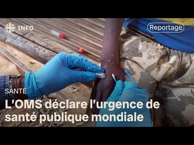 ⁣Résurgence de la MPOX en Afrique : l’OMS déclare l’urgence de santé publique internationale