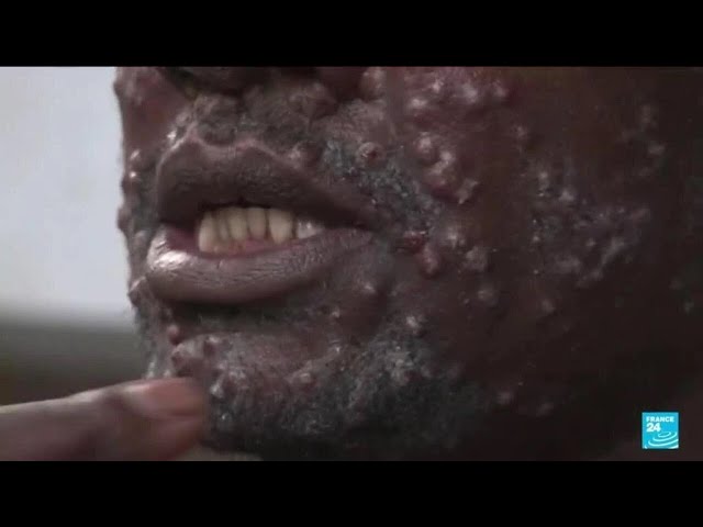 Mpox : un premier signalement en Suède, l'OMS alerte sur le risque d'autres cas importés e