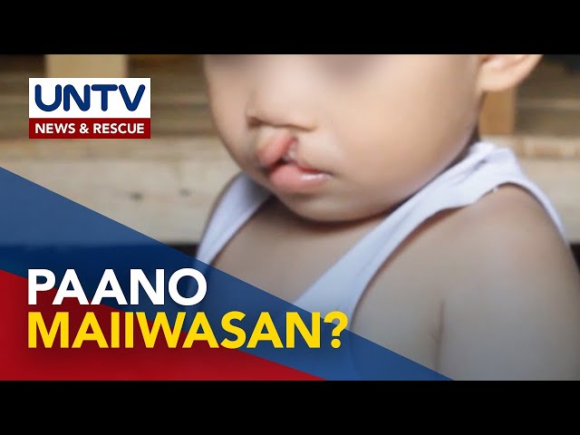 ⁣ALAMIN: Bingot o cleft lip and palate sa baby, paano maiiwasan?