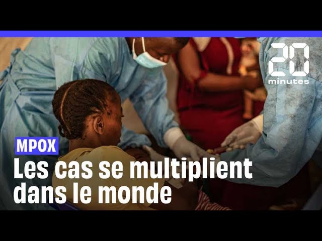 Mpox : Vers une multiplication des cas dans le monde ?