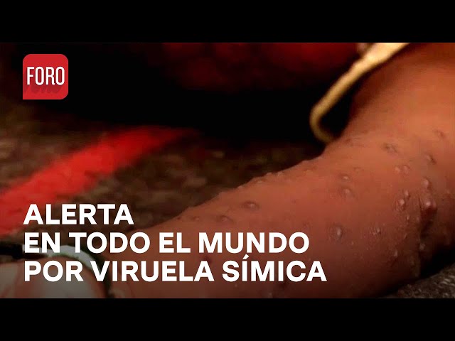 ¿Por qué la OMS declara alerta mundial por la viruela símica? - Sábados de FORO