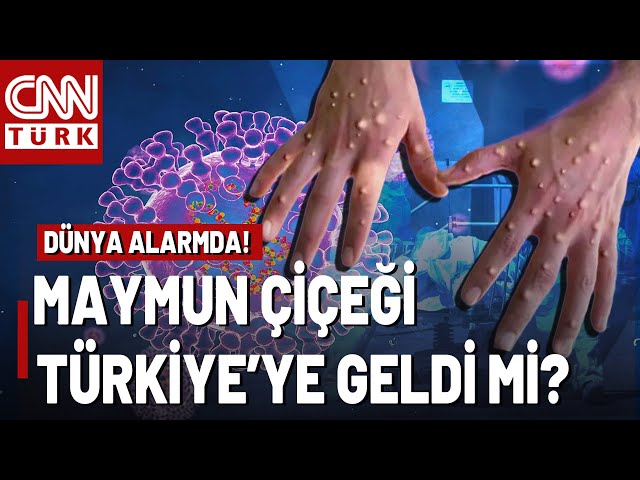 Küresel ACİL Durum İlan Edildi! Maymun Çiçeği Virüsü Nasıl Bulaşır?