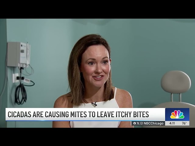 ⁣Itchy mite bites linked to cicada invasion on the rise