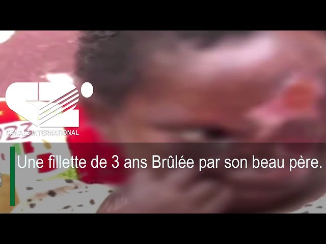 ⁣Une fillette de 3 ans Brûlée par son beau père.