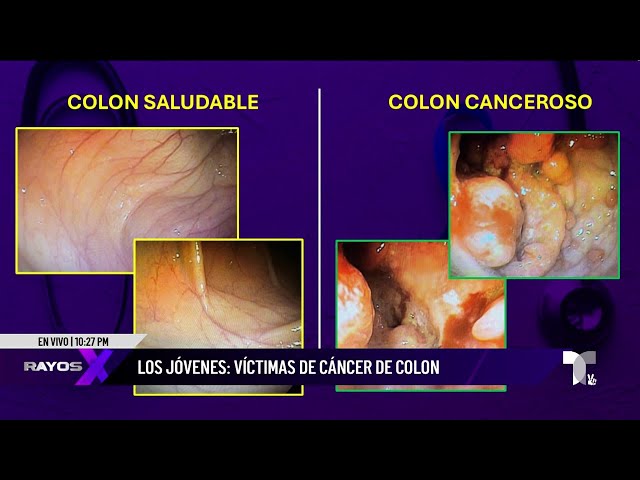 ⁣¡Alerta! Cáncer de colon causa estragos entre menores de 40 años.