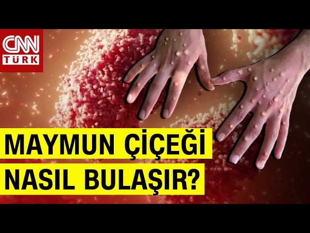 ⁣Dünya Diken Üstünde: Maymun Çiçeği Virüsü Yeni Covid-19 Mu? Tekrar Kapanma Olacak Mı?