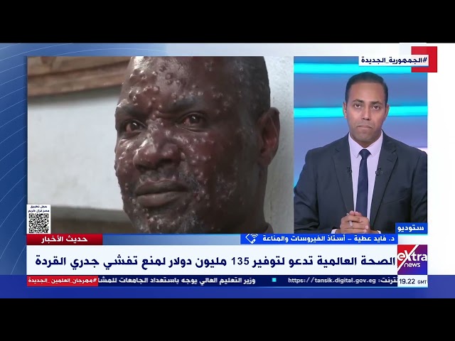 ⁣هل حدث تحور لفيروس جدري القردة خلال السنوات الأخيرة؟.. د. فايد عطية أستاذ الفيروسات والمناعة يُجيب