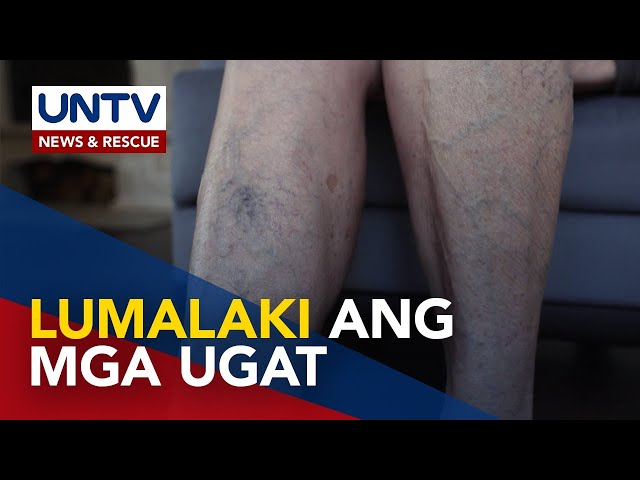 ⁣ALAMIN: Naglalakihang ugat sa binti o varicose veins, paano malulunasan?