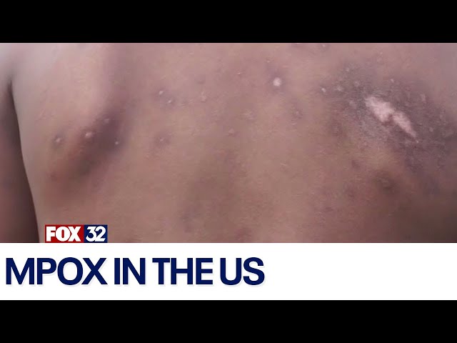 ⁣WHO: Mpox infections on the rise