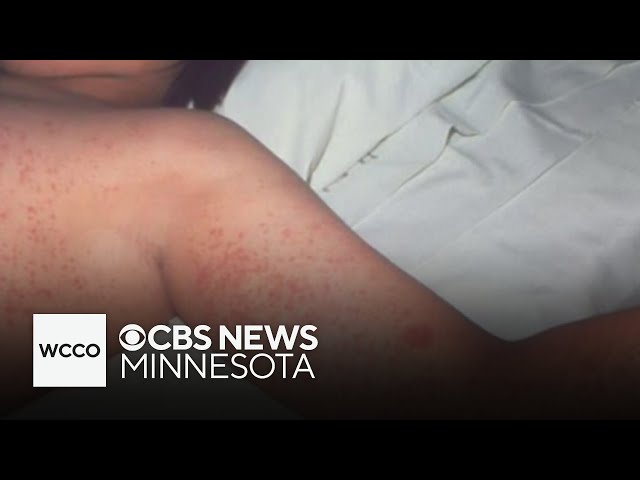 ⁣Minnesota facing growing number of measles cases