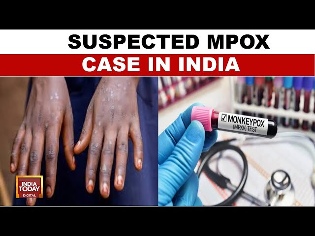 ⁣Mpox Case Suspected In Man Who Recently Travelled To India, Samples Under Test