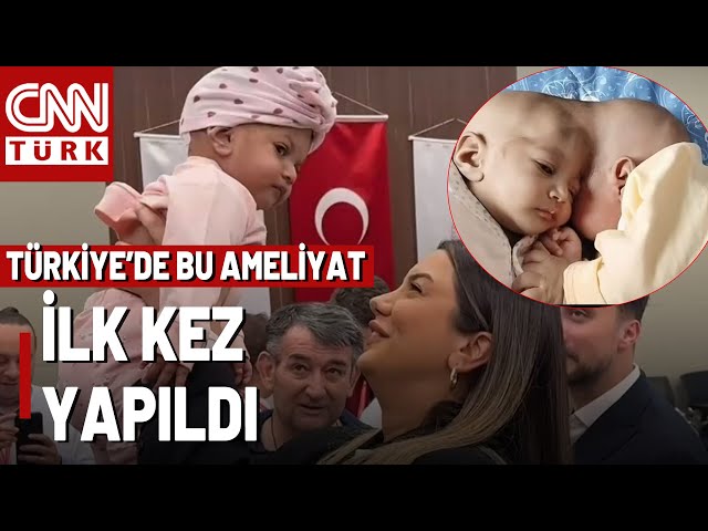 Türk Doktorlar Kafadan Yapışık İkizleri Ayırdı! 2,5 Milyonda Bir Görülen Vaka!