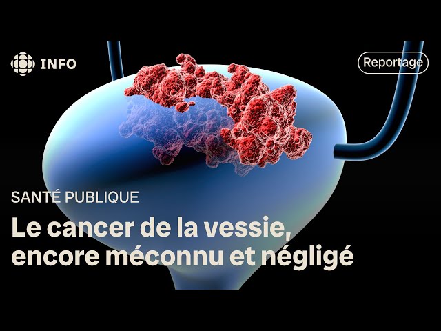 ⁣Le cancer de la vessie, encore méconnu et négligé