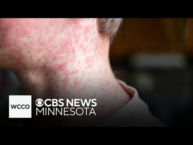 Measles confirmed in Minneapolis school, and more headlines